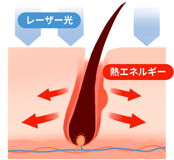 医療レーザー脱毛の仕組み２