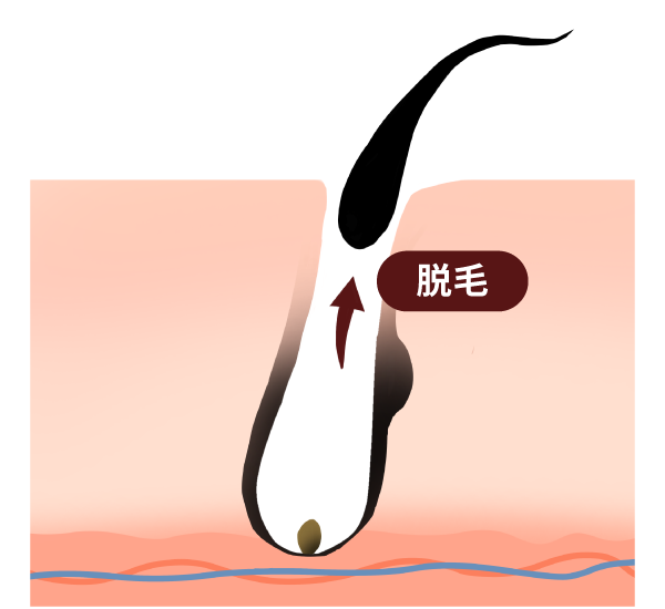 医療レーザー脱毛の仕組み３