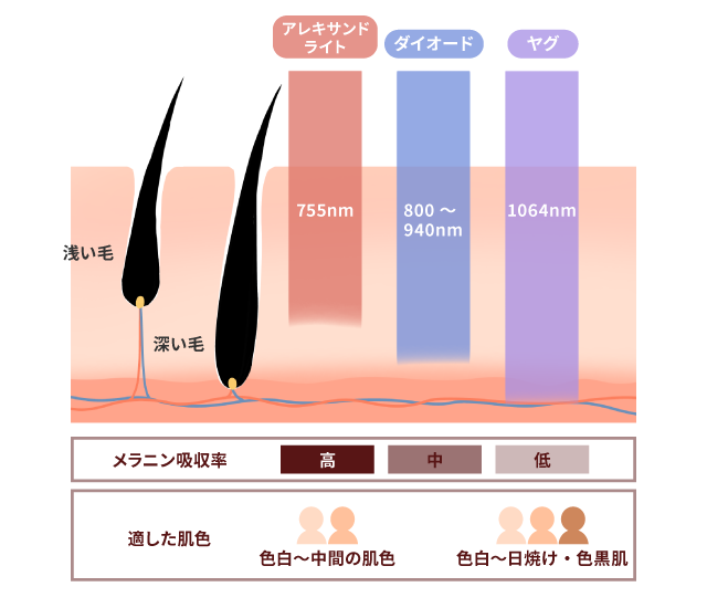脱毛レーザーの種類